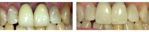 one-visit-crowns-before-after